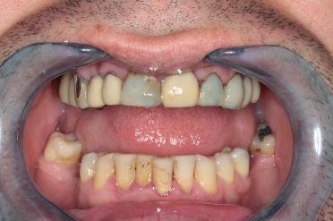 Faset - před zákrokem