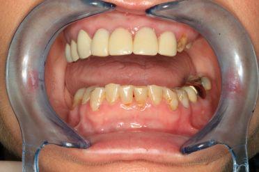 Metalokeramika - Klient 1 před zákrokem