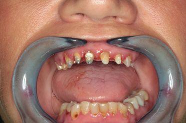 Metalokeramika - Klient 1 po sejmutí mostu