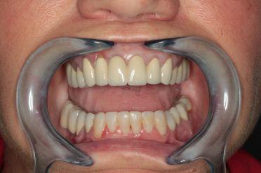 Metalokeramika - Klient 1 po zákroku