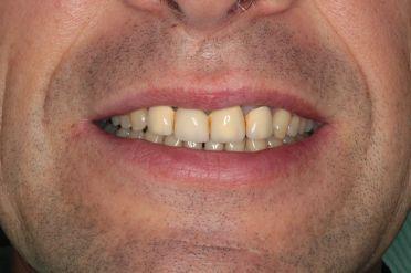 Metalokeramika - Klient 2 před zákrokem