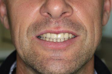 Metalokeramika - Klient 2 po zákroku