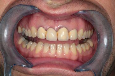 Metalokeramika - Klient 3 před zákrokem