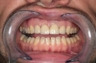 Metalokeramika - Klient 3 po zákroku